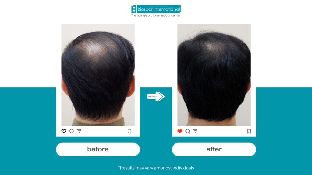 รูปผลลัพธ์การรักษาจาก BioScor ผมร่วงผมบาง จะเห็นได้ว่าผมขึ้นมากกว่าเดิมอย่างมาก