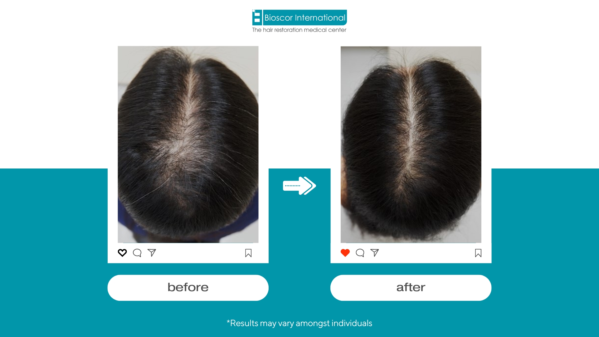 หลังได้รับการรักษาจาก Bioscor ทำให้ผมกลับมาดกดำเหมือนเก่า