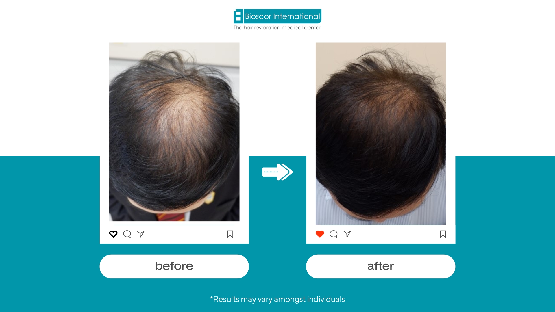 ผลลัพธ์ของการรักษาที่ BioScor ทำให้ผมบางกลับมามีเส้นผม และดกดำมากขึ้น